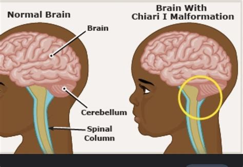 Height at the withers Males 20. . Things to avoid with chiari malformation